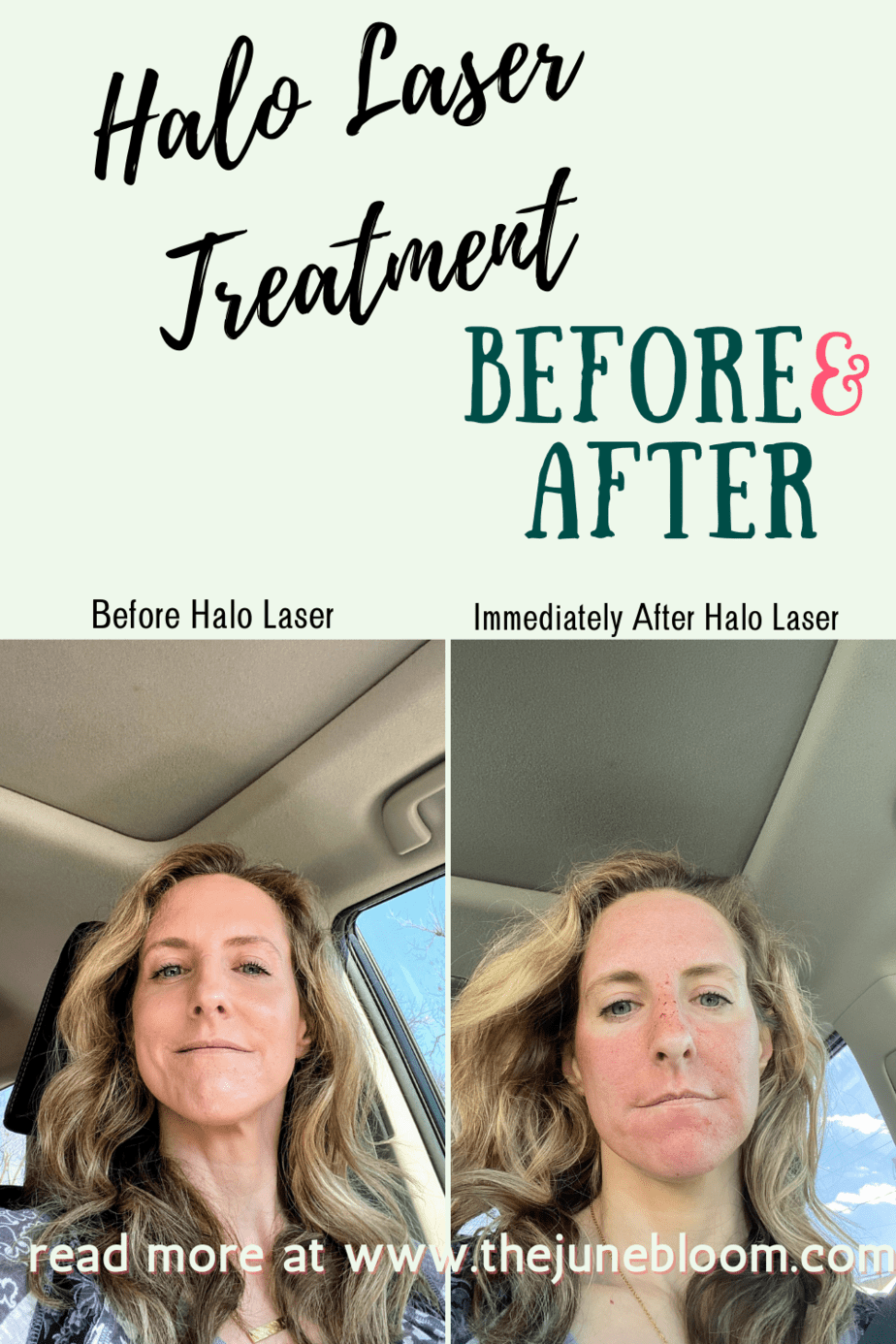 Does halo laser treatment really work